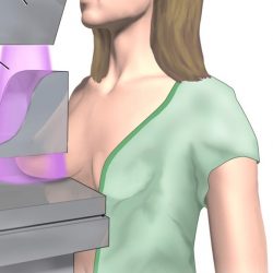 Un nuevo convenio en materia de salud por parte de la actual Administración y clínica privada, permitirá efectuar mamografías a mujeres de la comuna